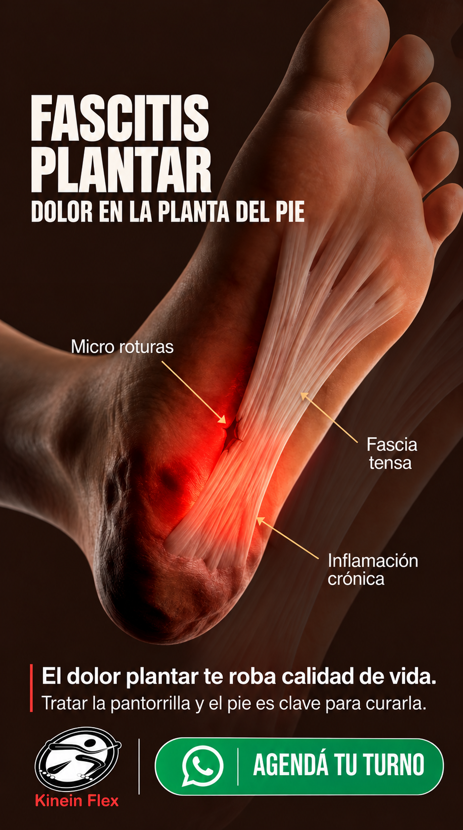 Publicación de Kinein Flex sobre fascitis plantar, dolor e inflamación