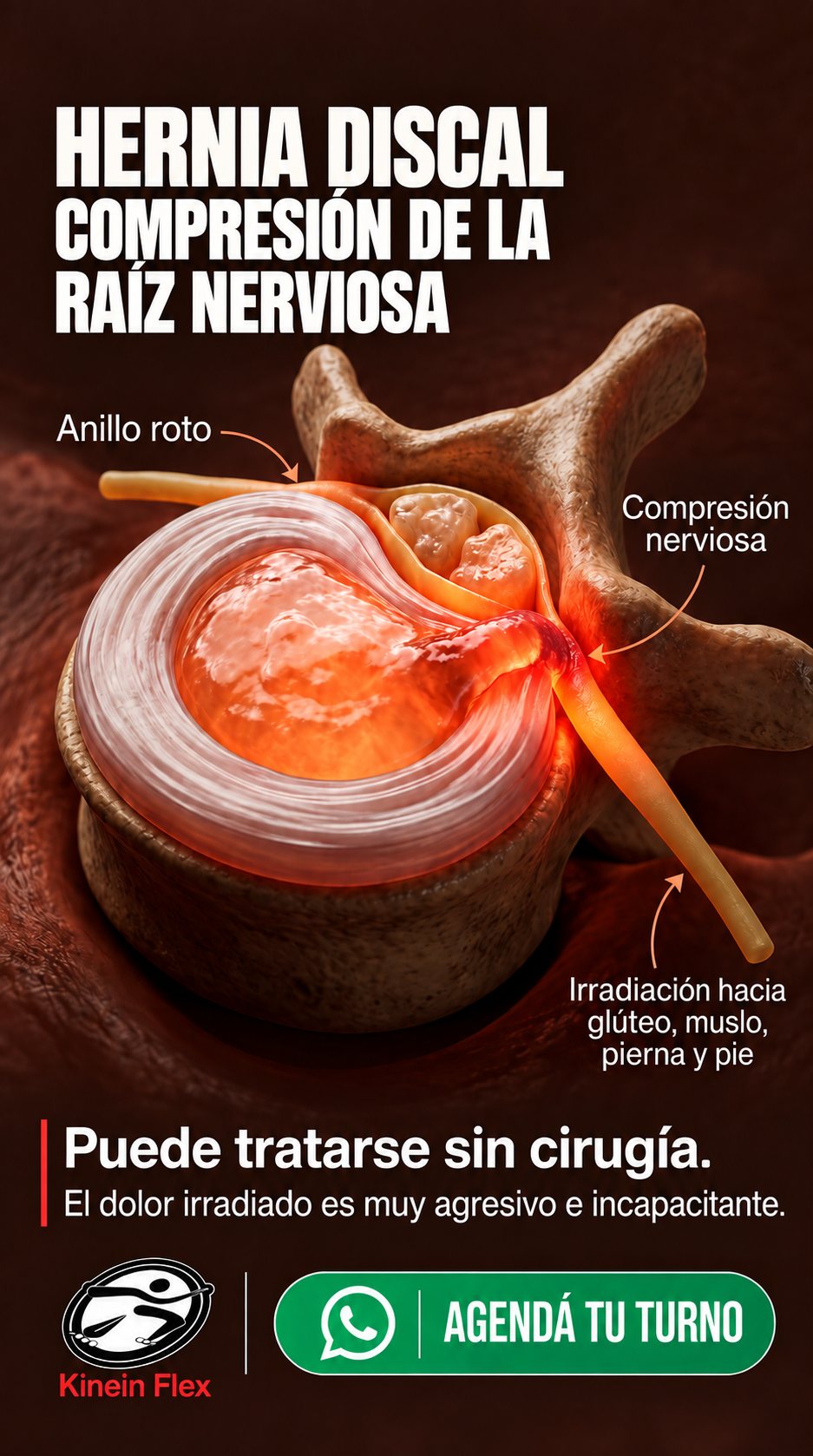 Publicación de Kinein Flex sobre hernia discal y compresión de la raíz nerviosa