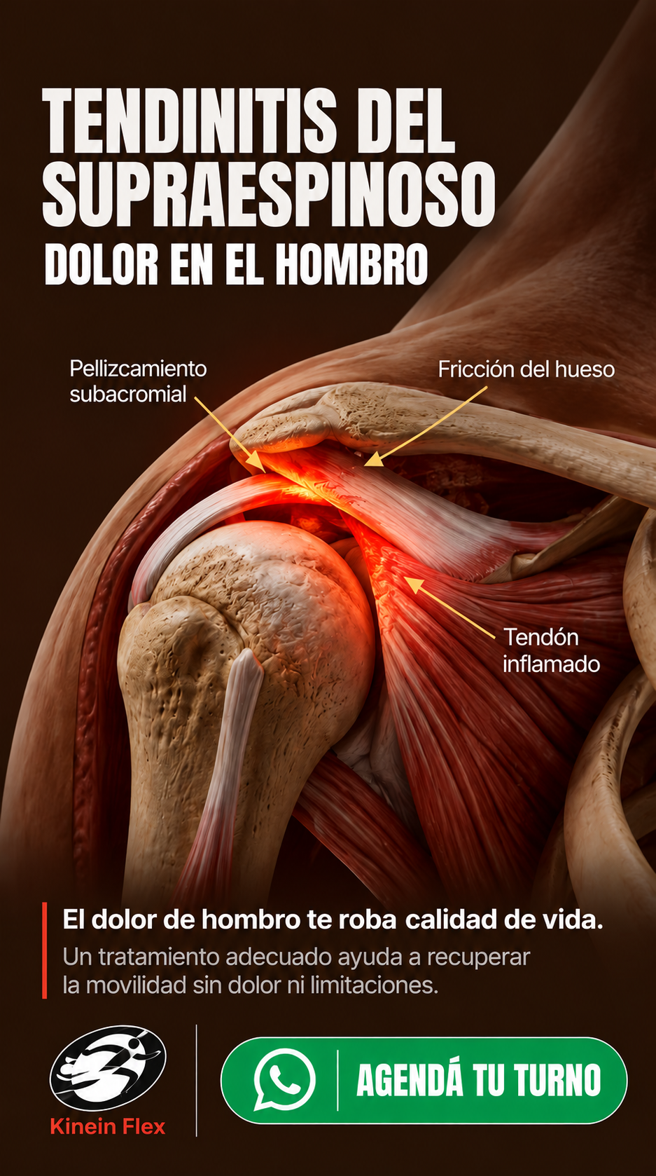 Publicación de Kinein Flex sobre tendinopatía del supraespinoso y dolor de hombro