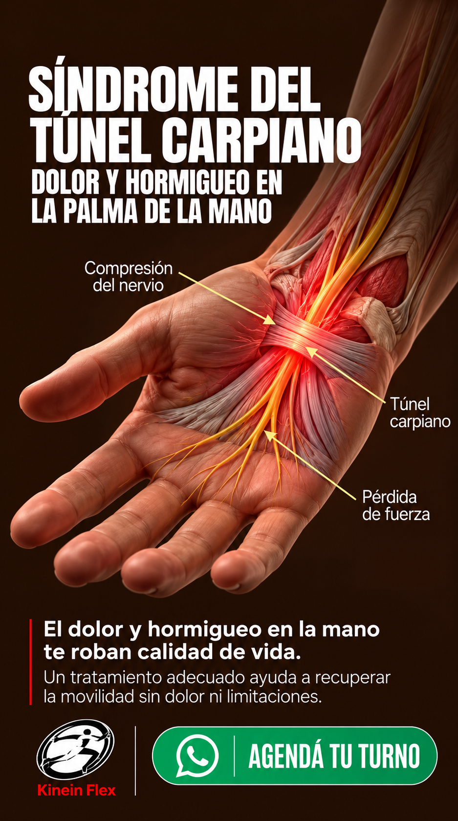 Publicación de Kinein Flex sobre síndrome del túnel carpiano, hormigueo y pérdida de fuerza